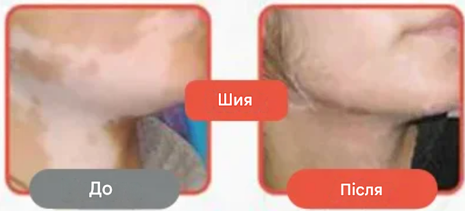 Baiyaolang — Трав’яний крем від свербіжу та шкірних проблем
